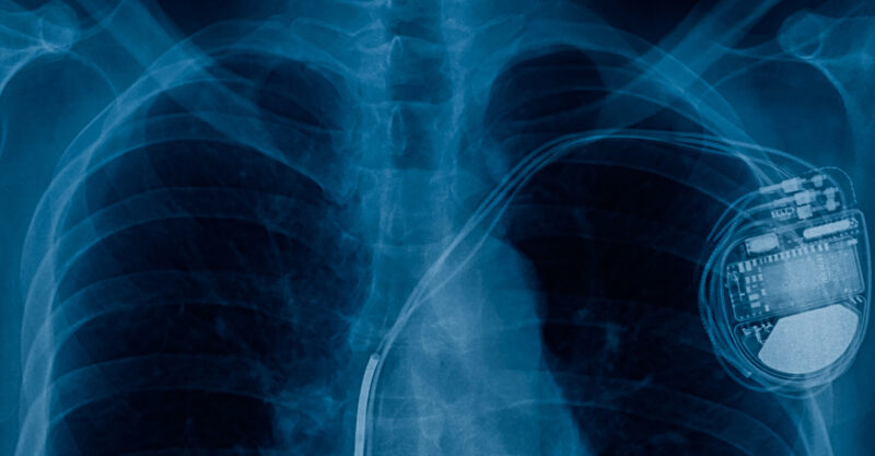 X-ray image showing pacemaker in chest.
