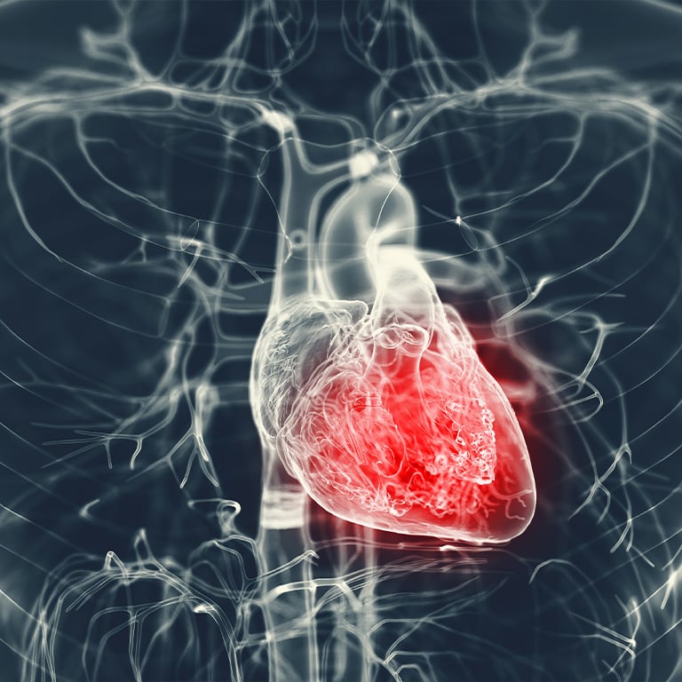 3d medical illustration of a man's inflamed heart