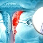uterus and glyphosate bottle