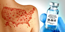 measles on a person's back in the shape of the US map and bottle of MMR vaccine
