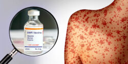 mmr vaccine and child with measles