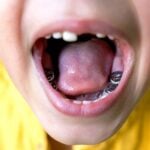 child with silver tooth fillings