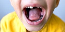 child with silver tooth fillings