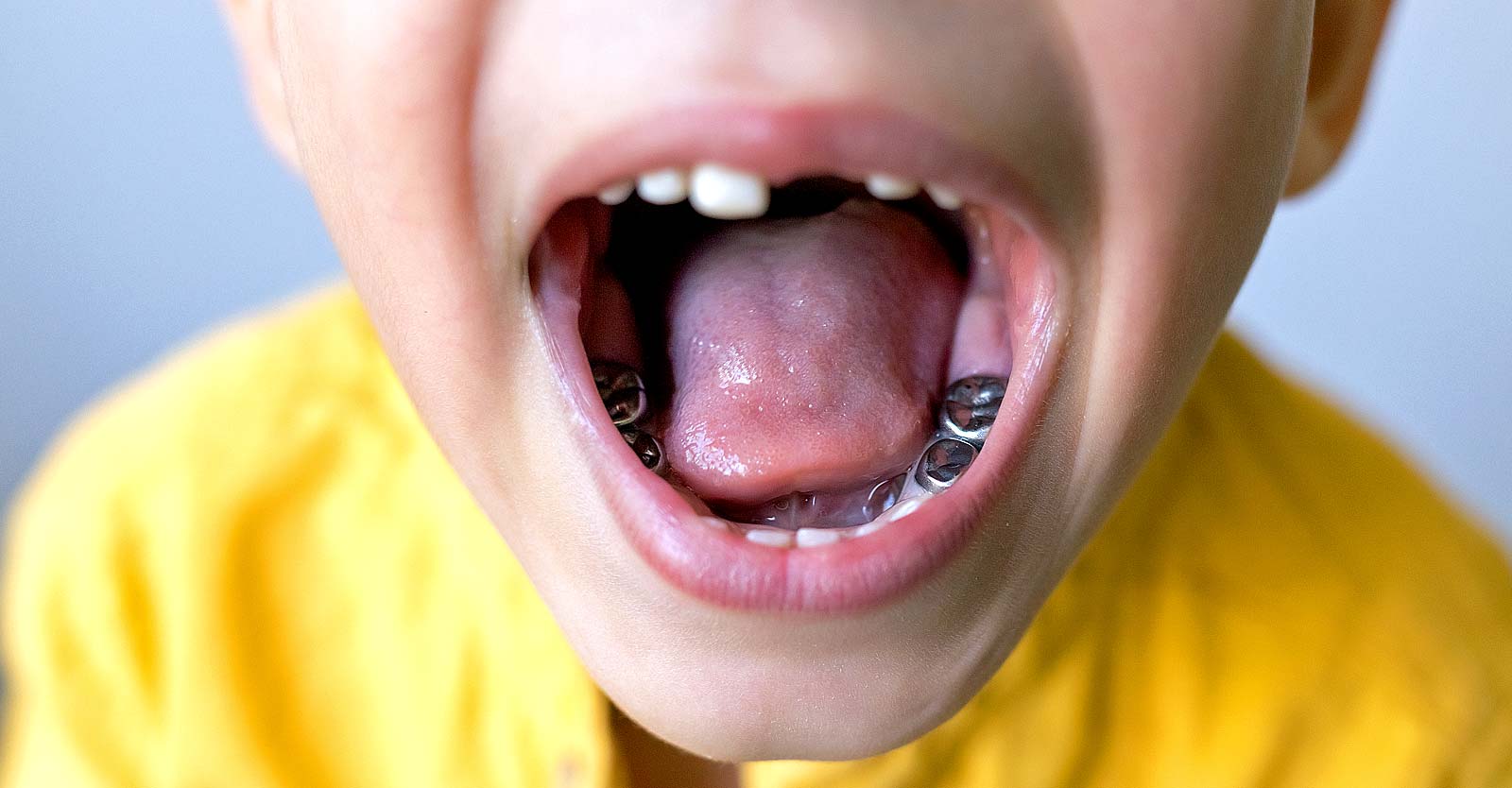 child with silver tooth fillings
